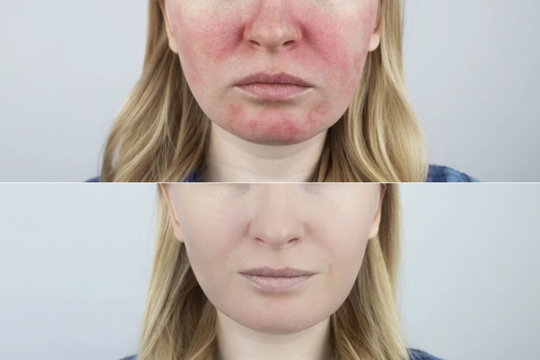 What Calms Rosacea Down and What Makes It Flare?