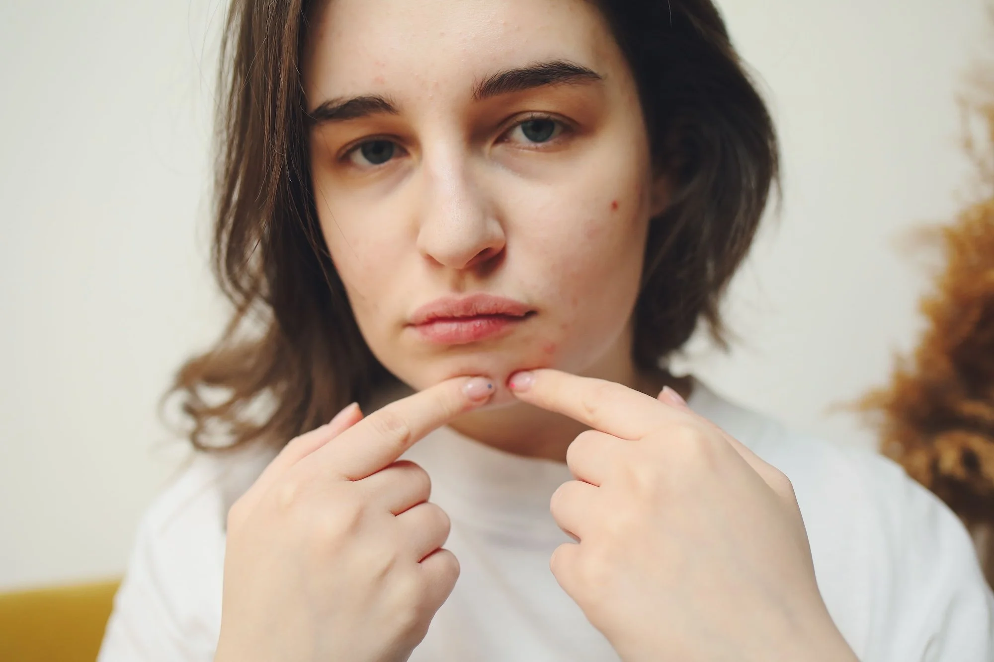 Adult Acne: Why It's Not the Same as Teenage Acne (and What Actually Helps)