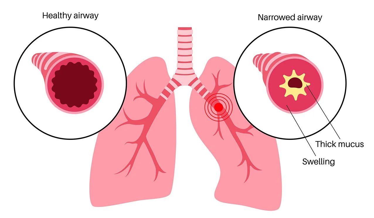 Dr Harvey Kok Sleep Respiratory Physician Sydney Newcastle Little Lungs