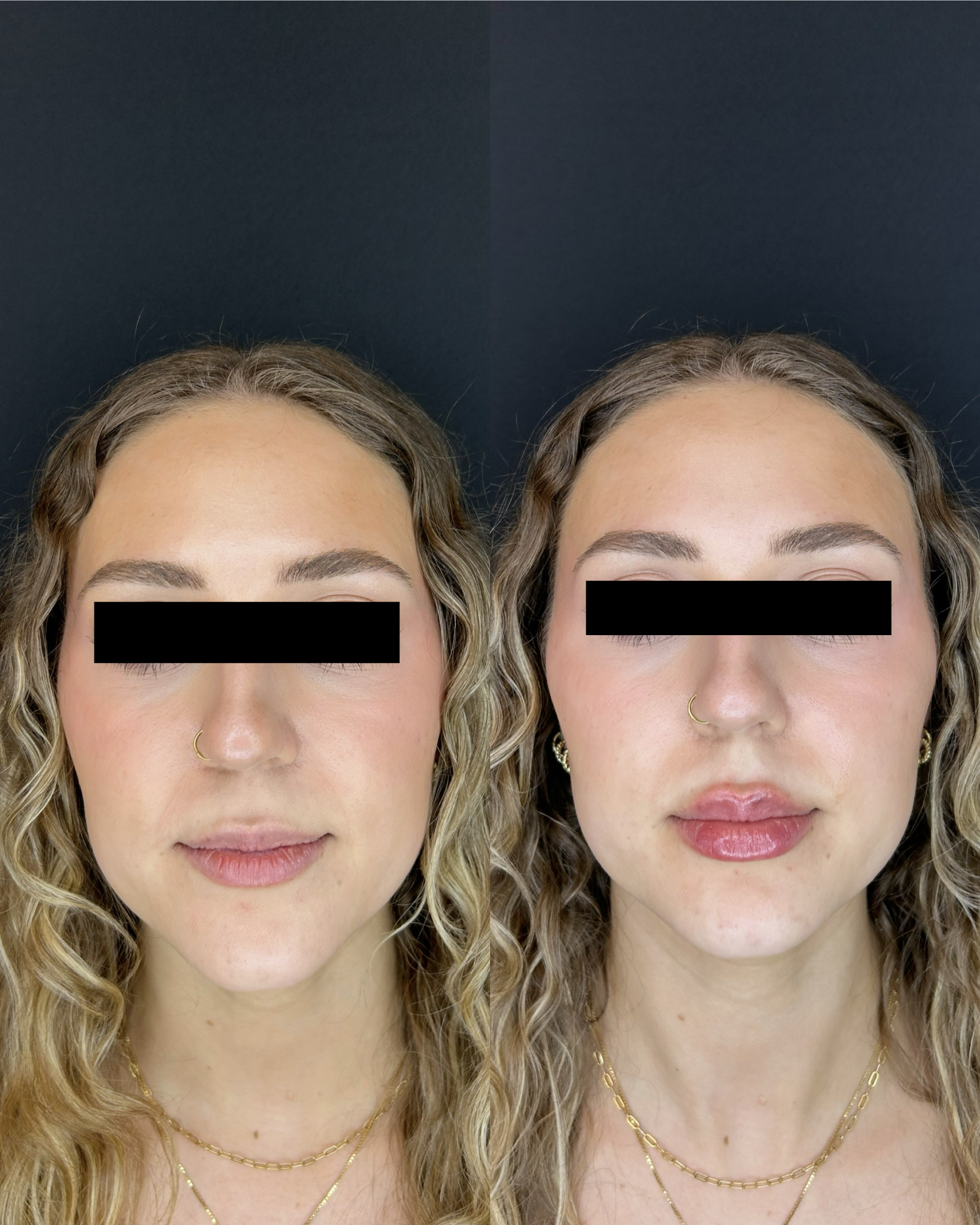 Side-by-side comparison of a woman before and after facial treatment, showing clear skin and improved complexion.