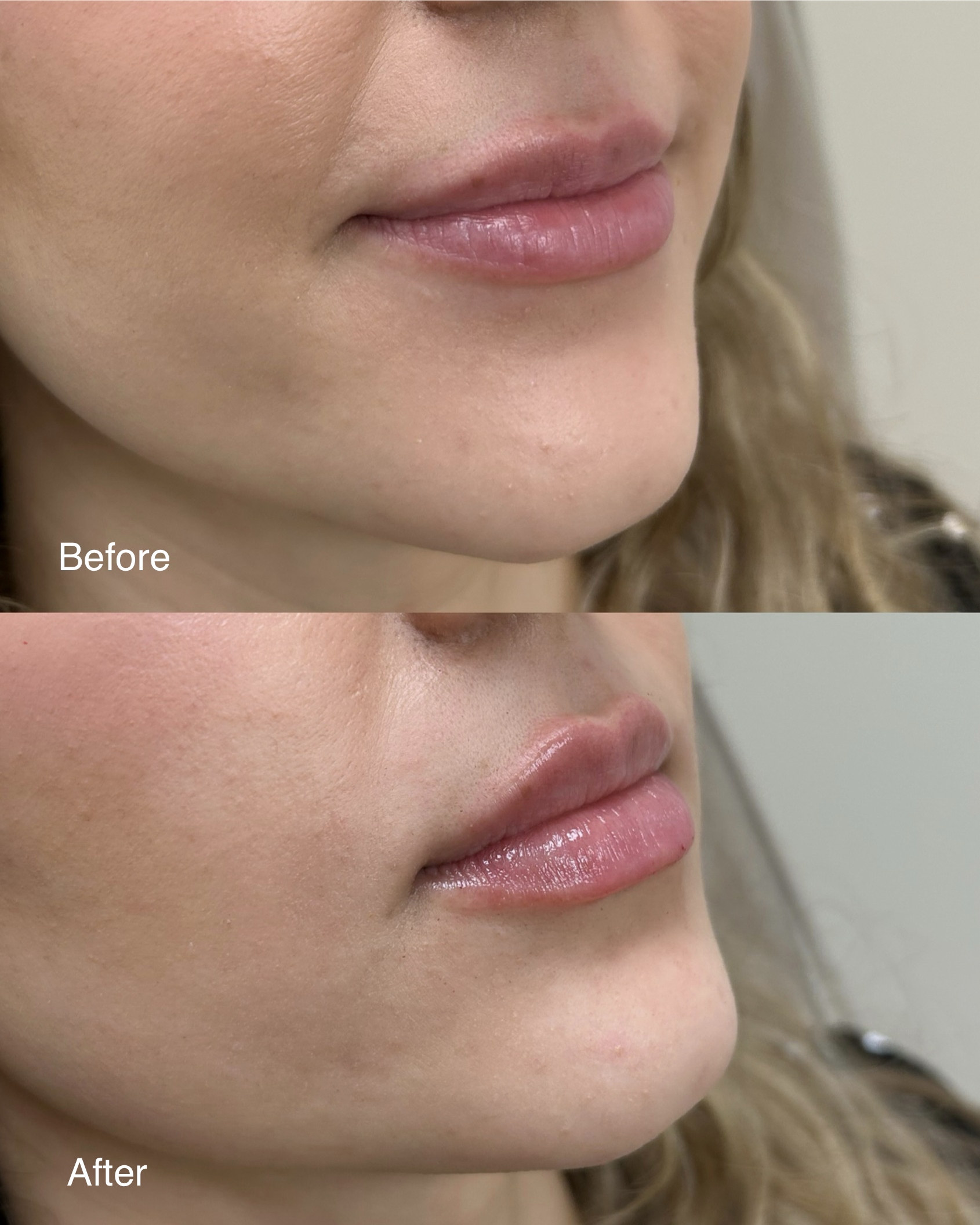 Close-up of a woman's lips after cosmetic enhancement, with smooth and well-defined lips, and clear skin around the mouth.