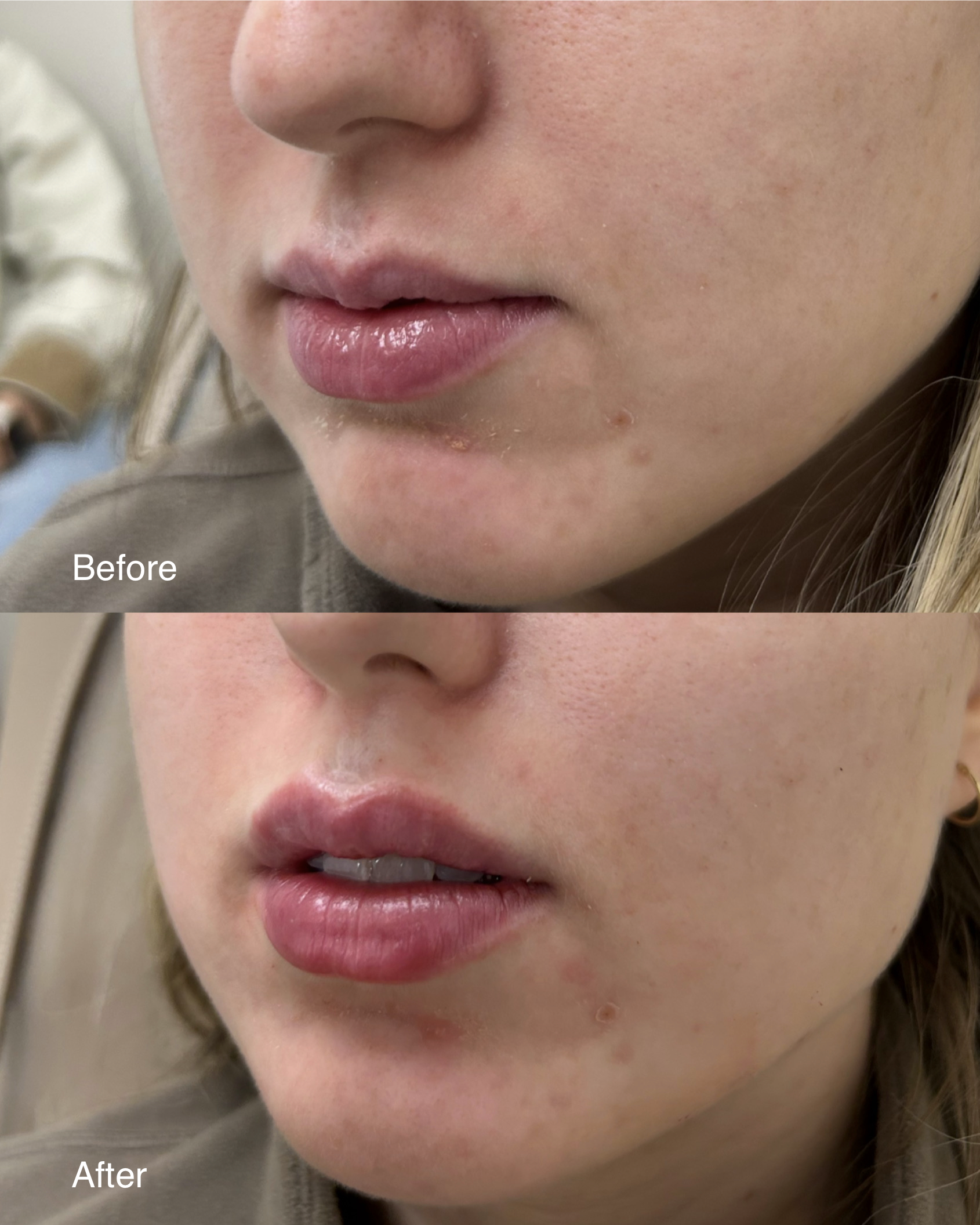 Close-up of a woman's face before and after cosmetic lip and skin treatment, showing fuller lips and smoother skin.