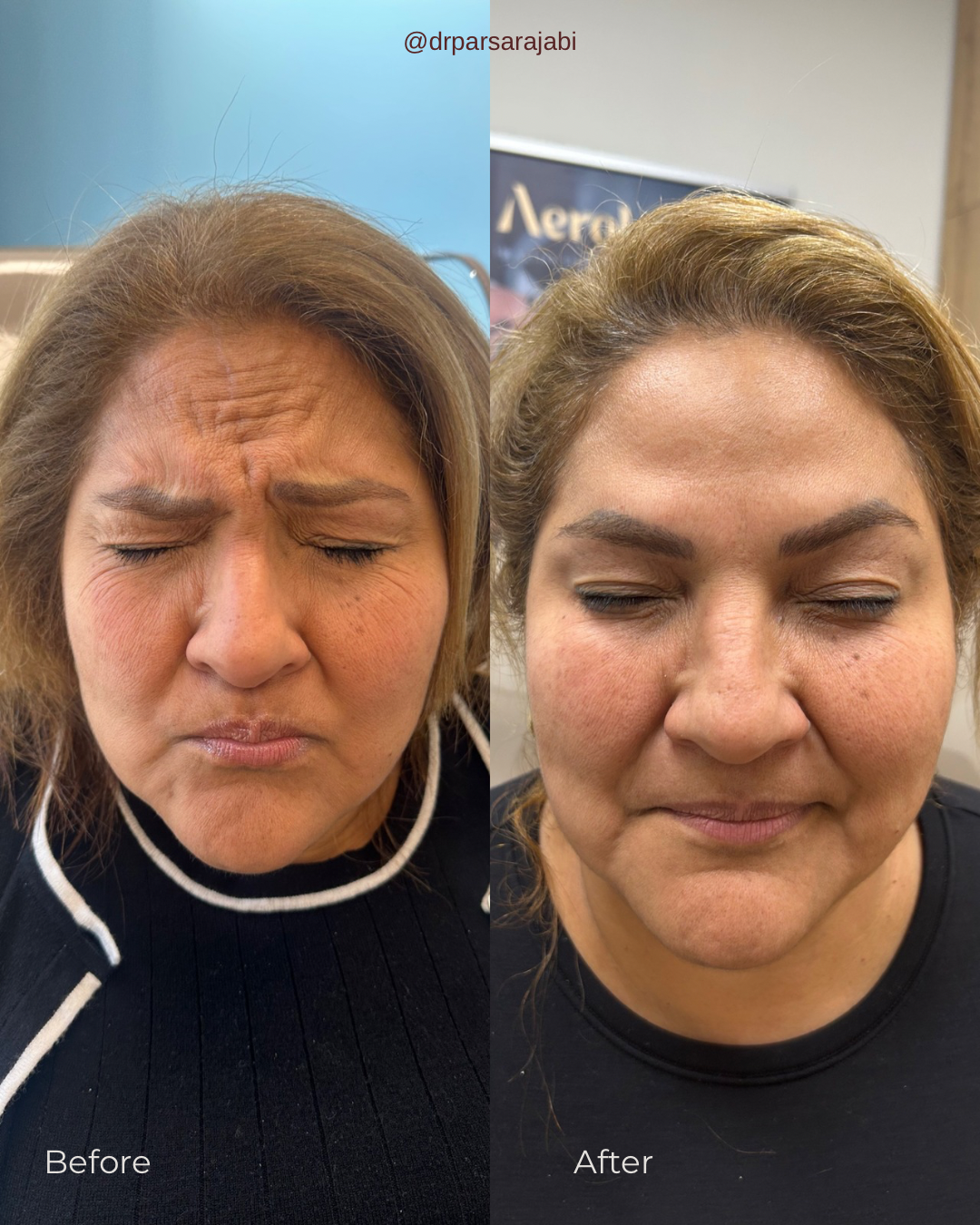 Comparison of a woman's face before and after a cosmetic treatment, showing reduced wrinkles and smoother skin.