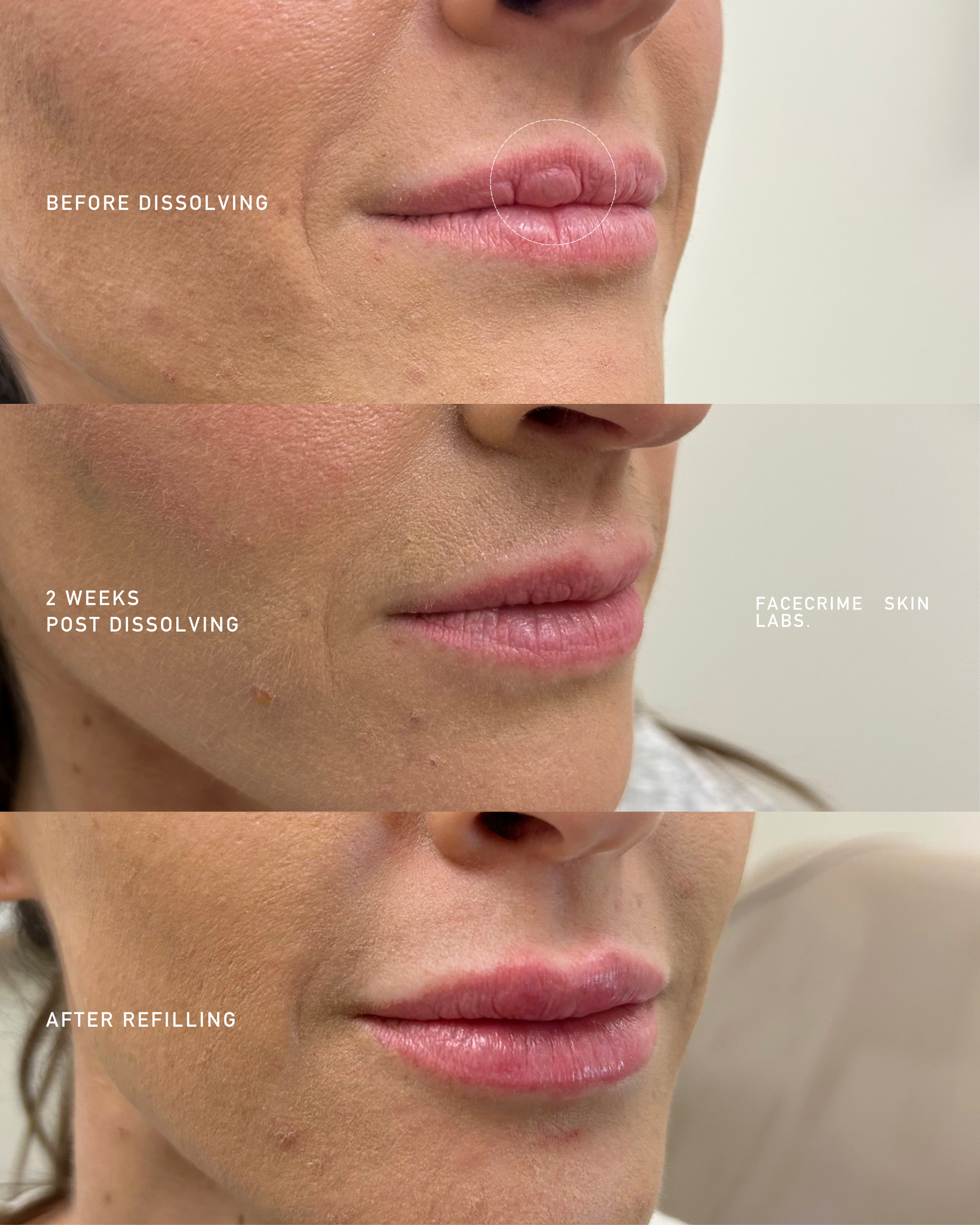 Close-up of a woman's face showing the lips, nose, and part of the cheeks. The photo is divided into three sections labeled 'Before Dissolving,' '2 Weeks Post Dissolving,' and 'After Refiling,' depicting the progression of lip enhancement treatment over time.
