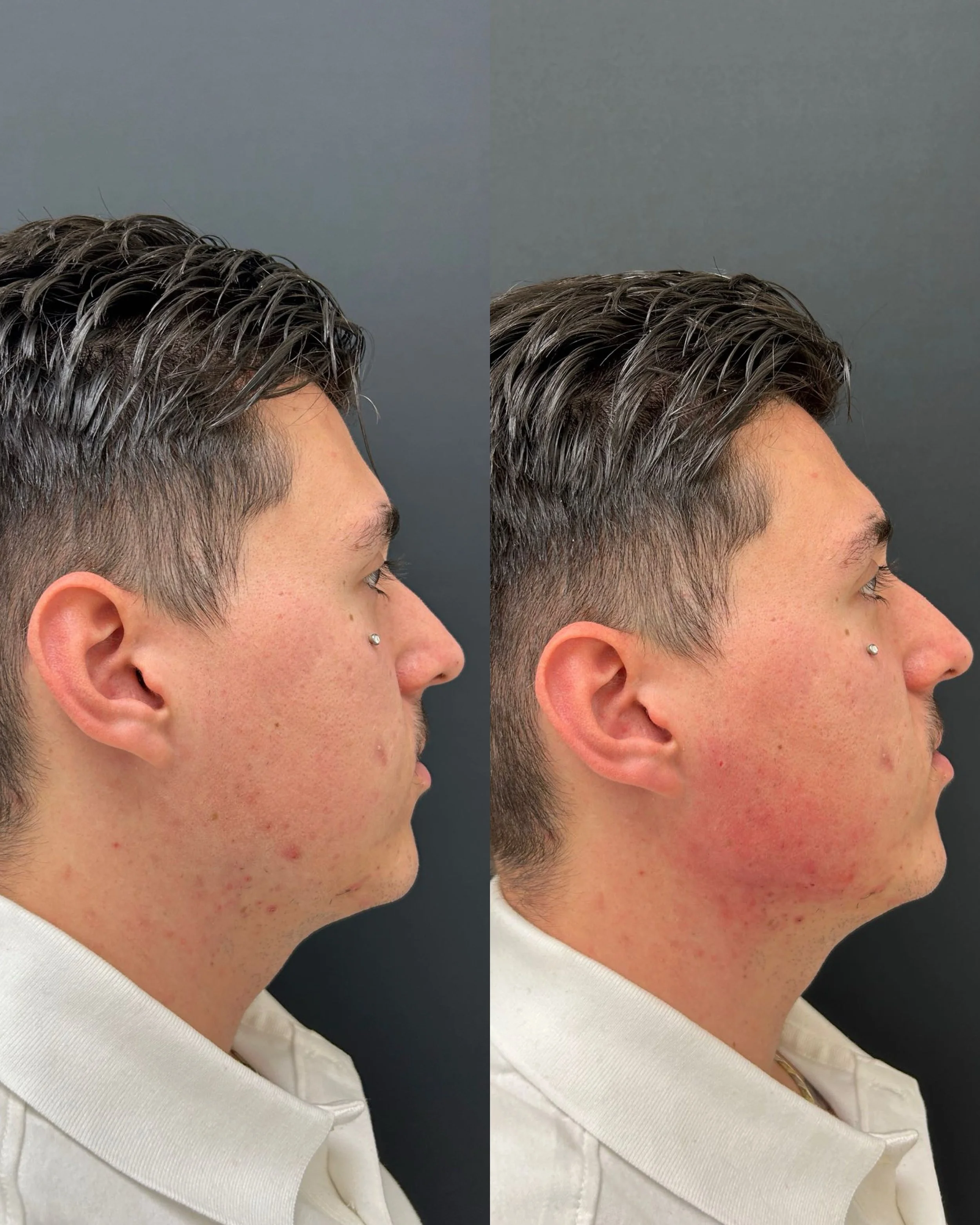 Comparison of a man's face before and after skincare, showing improved skin condition, with decrease in redness and blemishes.