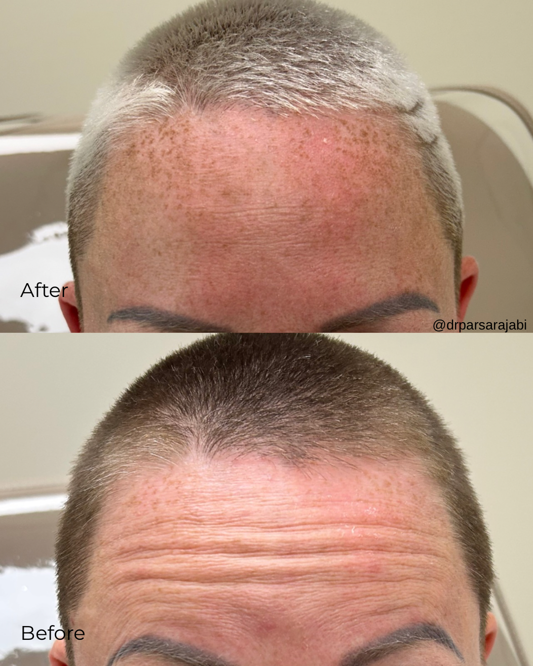Before and after images showing a woman's forehead with hair follicle transplant results, with the ‘after’ image displaying significant hair density improvement.