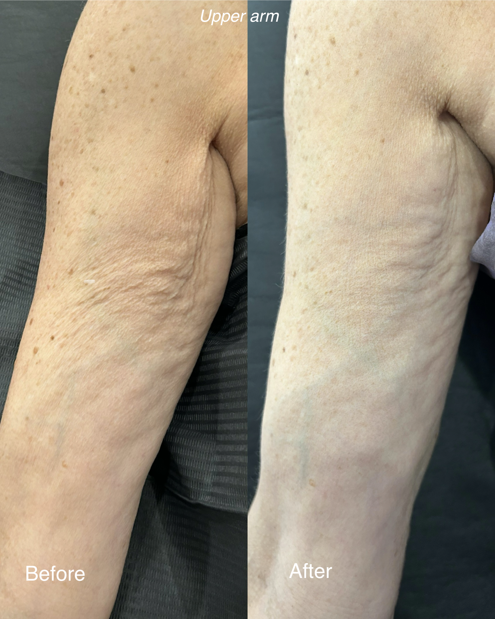 Comparison of the upper arm showing before and after skin improvement, with visible reduction in freckles and skin discoloration in the after image.