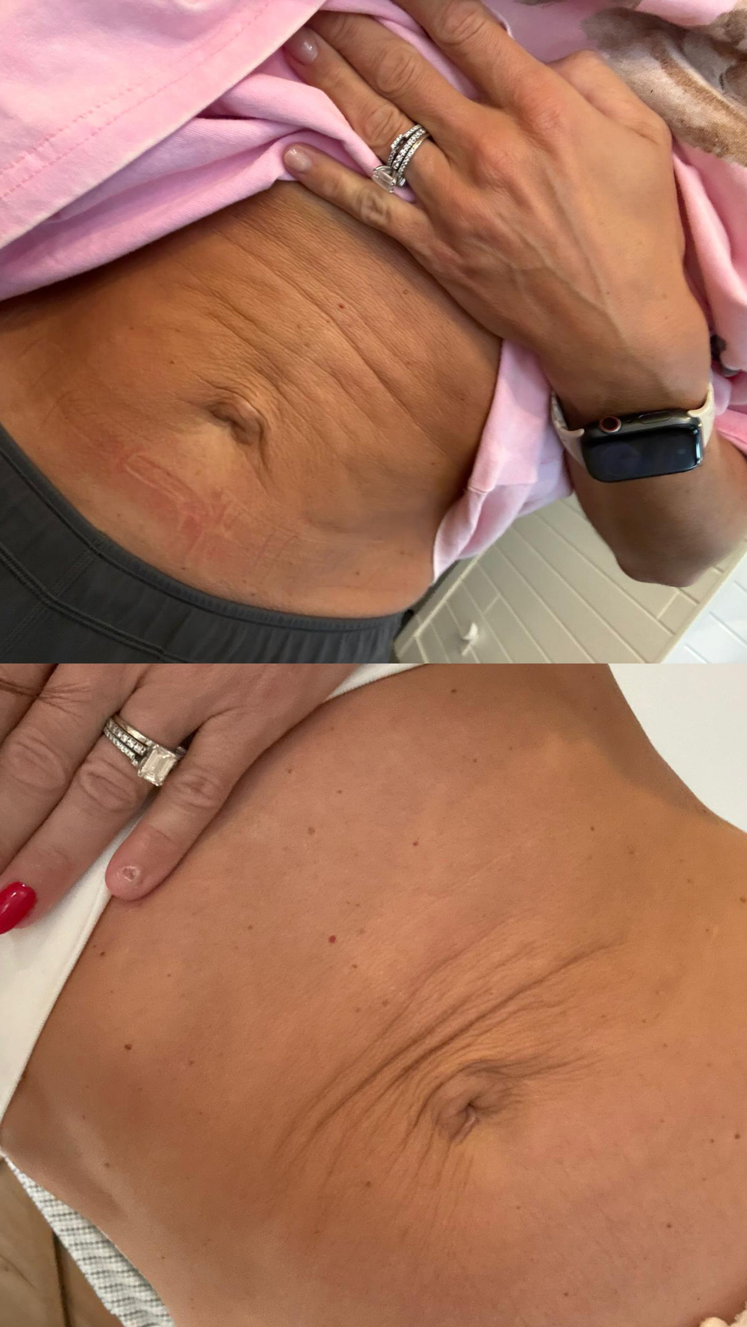 Close-up of a person's hand with a wedding ring resting on their stomach, which has some stretch marks. The person is wearing a smartwatch and a pink shirt. The second part shows a close-up of a person's shoulder and arm, also with a wedding ring.