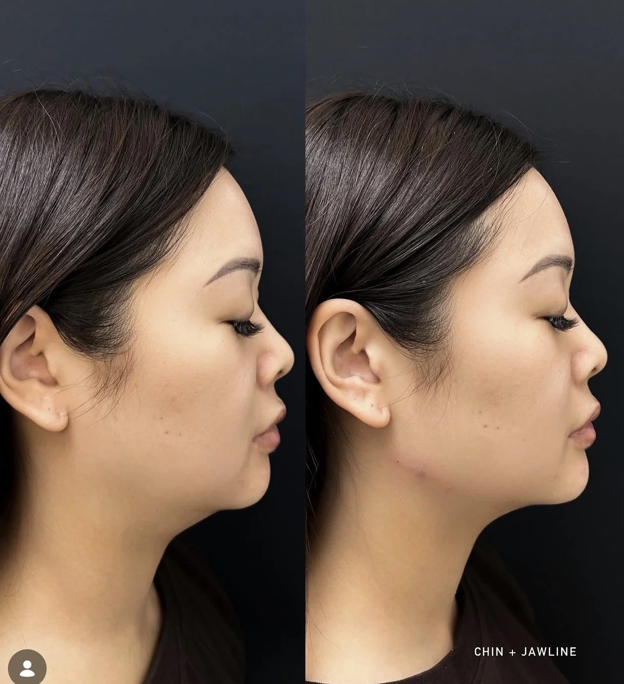 Side-by-side before and after images of a woman's facial profile showing chin and jawline changes.