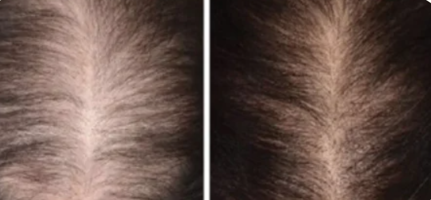 Close-up comparison of a person's scalp, showing hair thinning or hair loss before and after treatment.