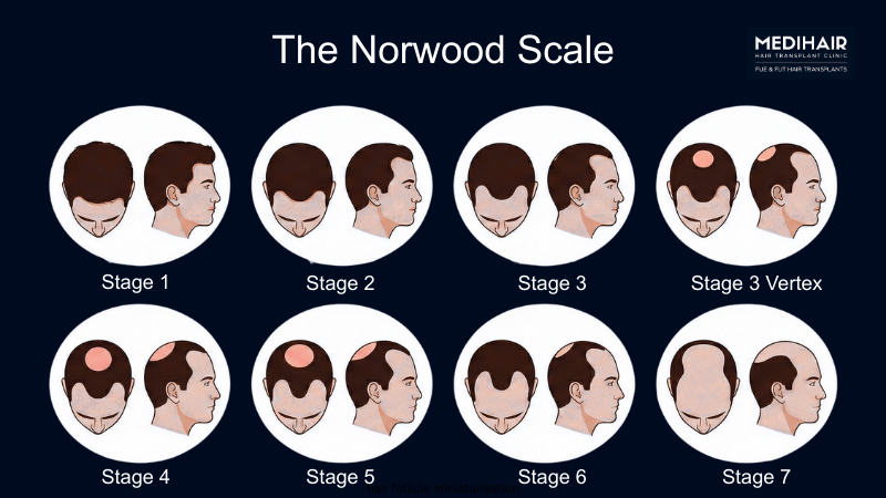 Illustration of the Norwood Scale showing seven stages of male hair loss, from stage 1 with normal hair to stage 7 with advanced baldness.