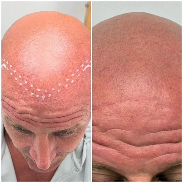 Comparison of a man's bald head before and after scalp micropigmentation tattooing, showing dotted markings on the forehead in the 'before' image and a completed, shaded effect in the 'after' image.