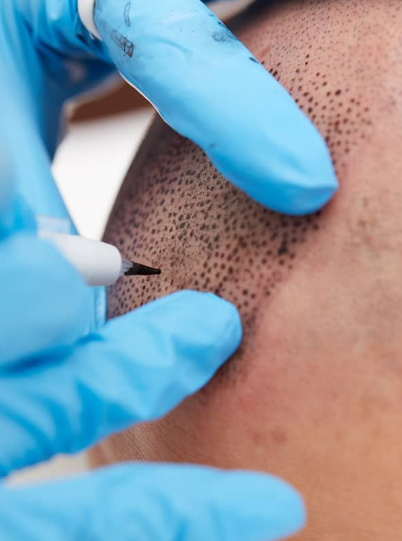 Close-up of a person receiving a micropigmentation tattoo to mimic hair follicles, with a technician wearing blue gloves.
