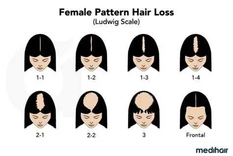 Diagram showing female pattern hair loss stages on the Ludwing scale, with images of women with varying degrees of hair thinning from 1-1 to 3, and frontal view.
