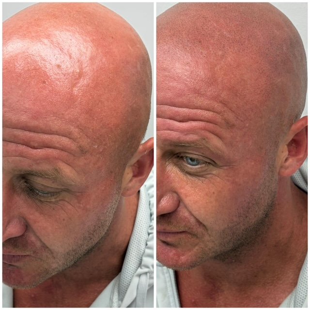 Comparison image showing a man's bald head before and after treatment, with improved skin appearance and fewer wrinkles.