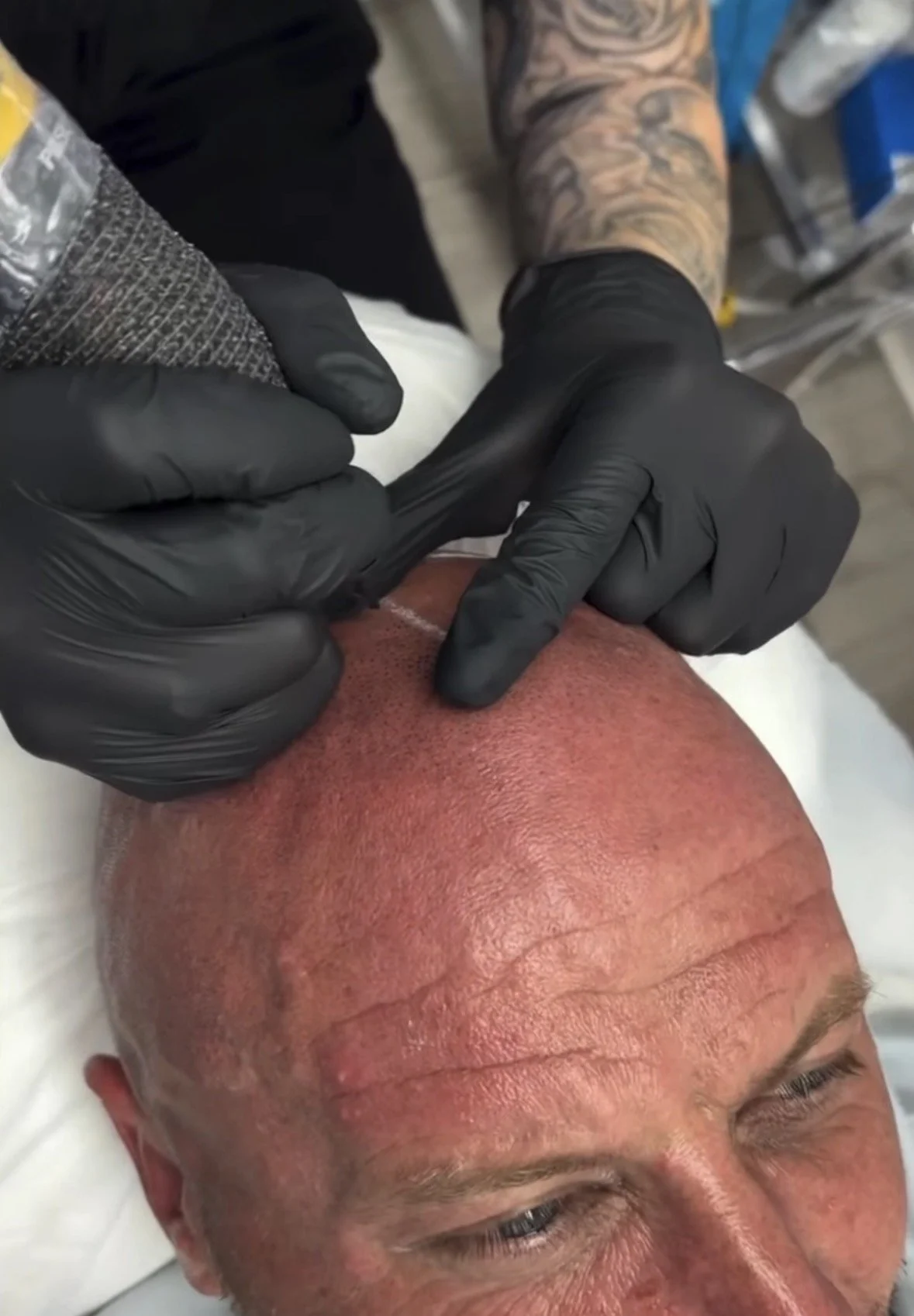 A person with a tattooed arm performing a tattoo procedure on a man's bald head in a clinical setting. The man is lying on a white surface.