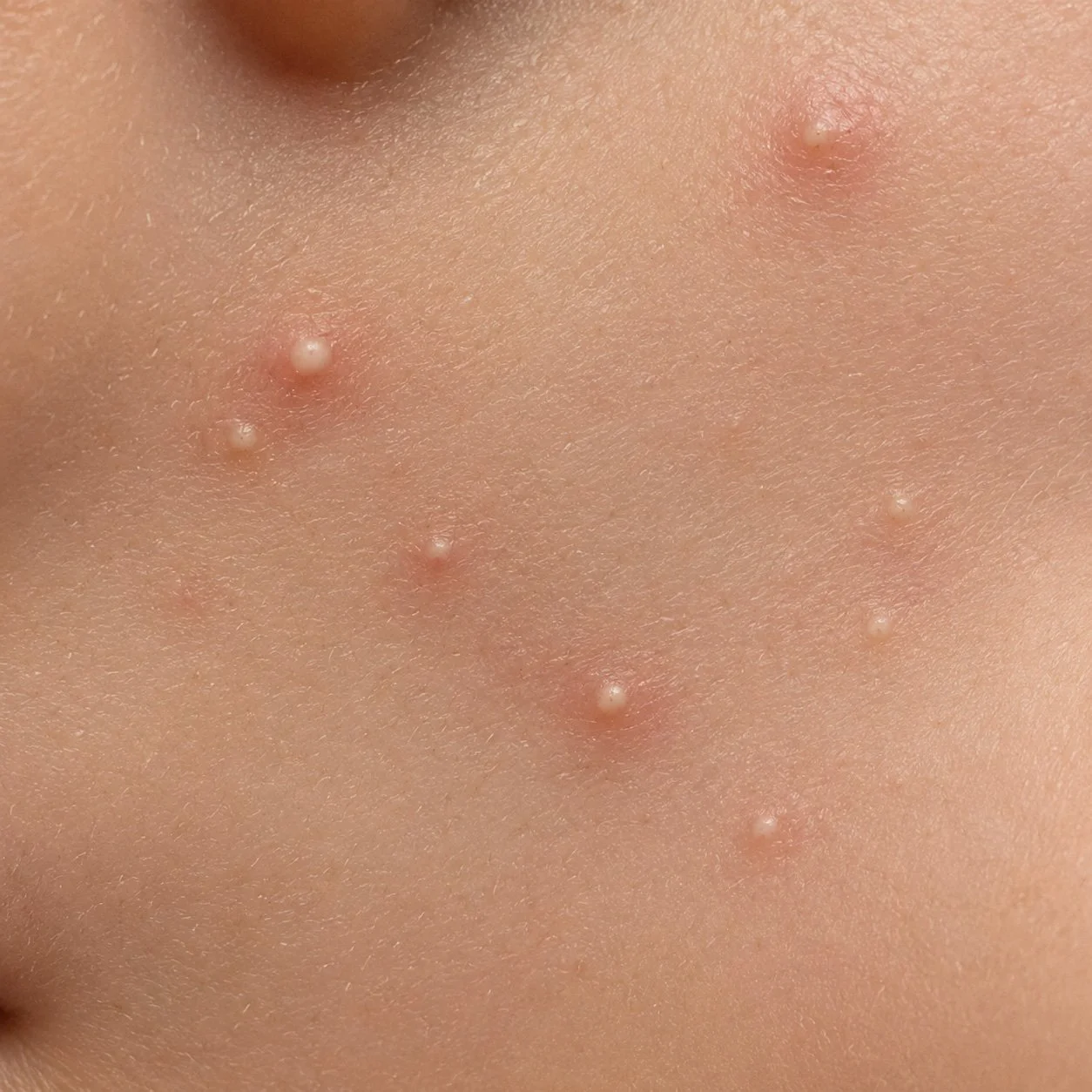 Close-up of skin with multiple small, raised, white pimples or pustules.