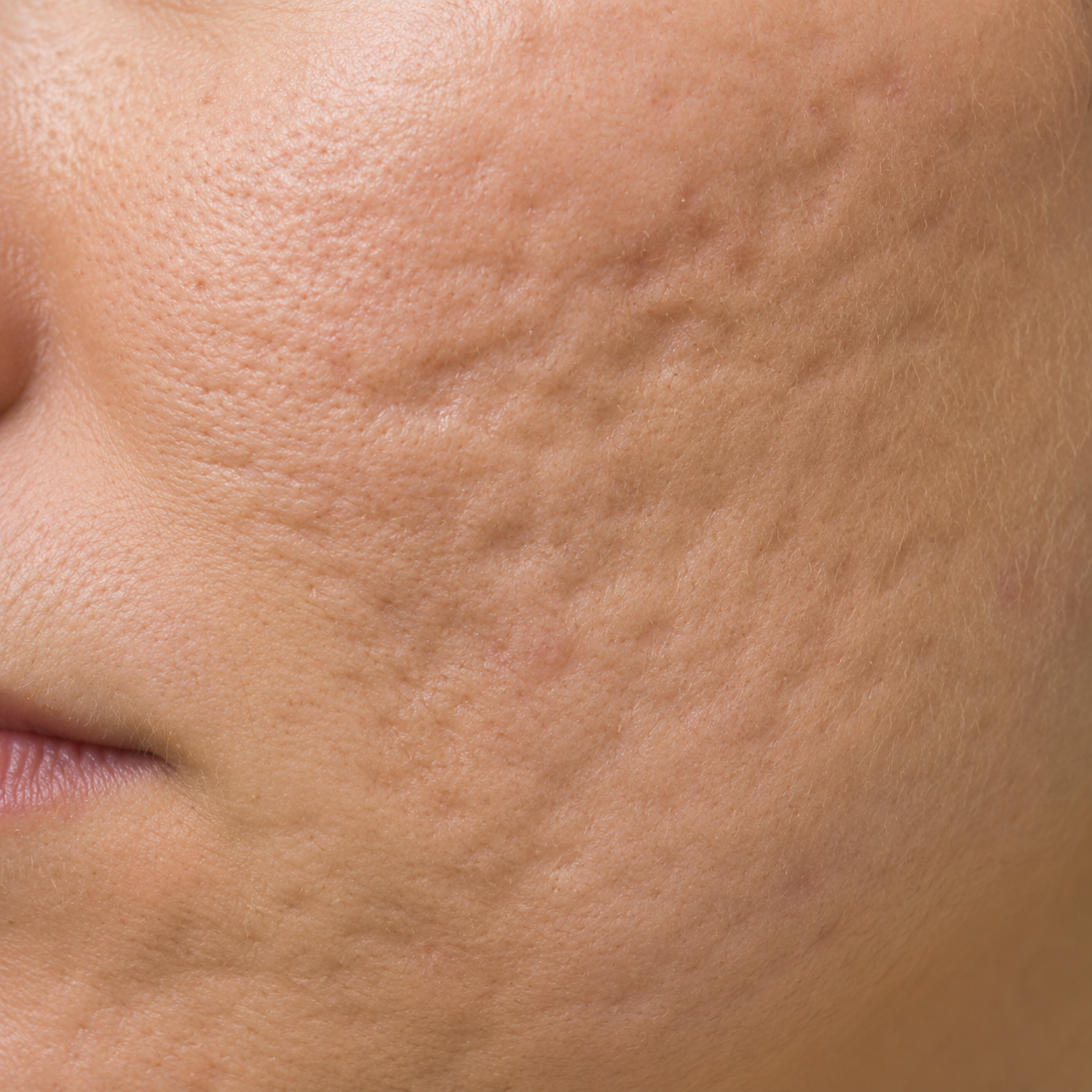Close-up of a person's cheek showing signs of acne scars and textured skin.