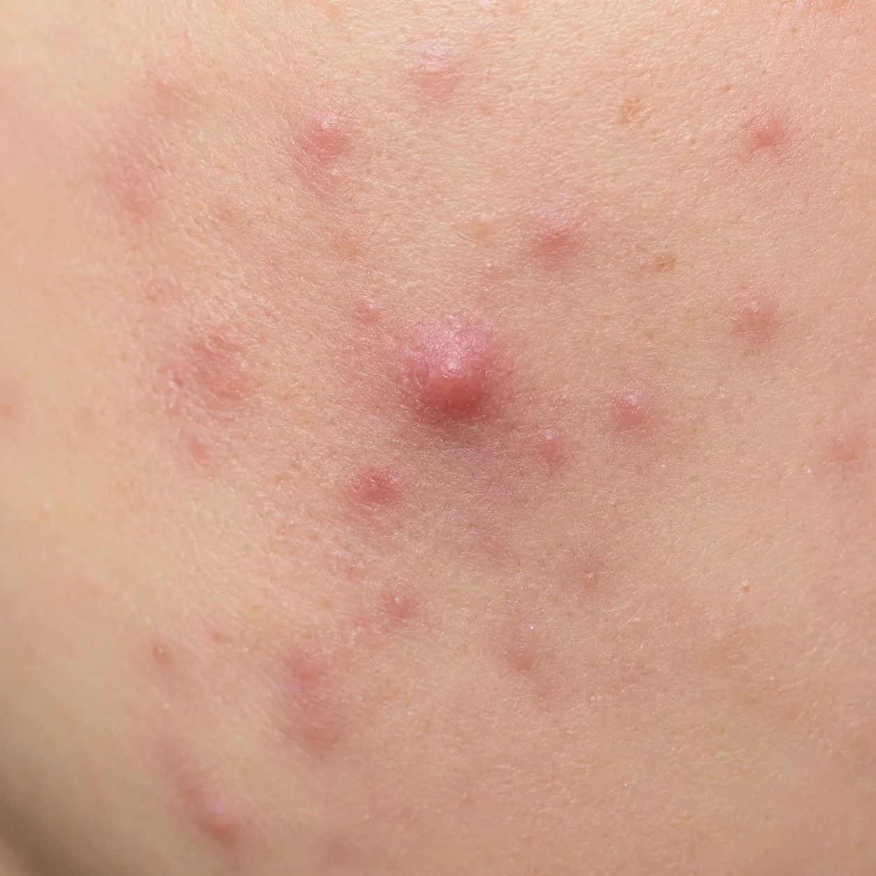 Close-up of skin with multiple red pimples and blemishes.