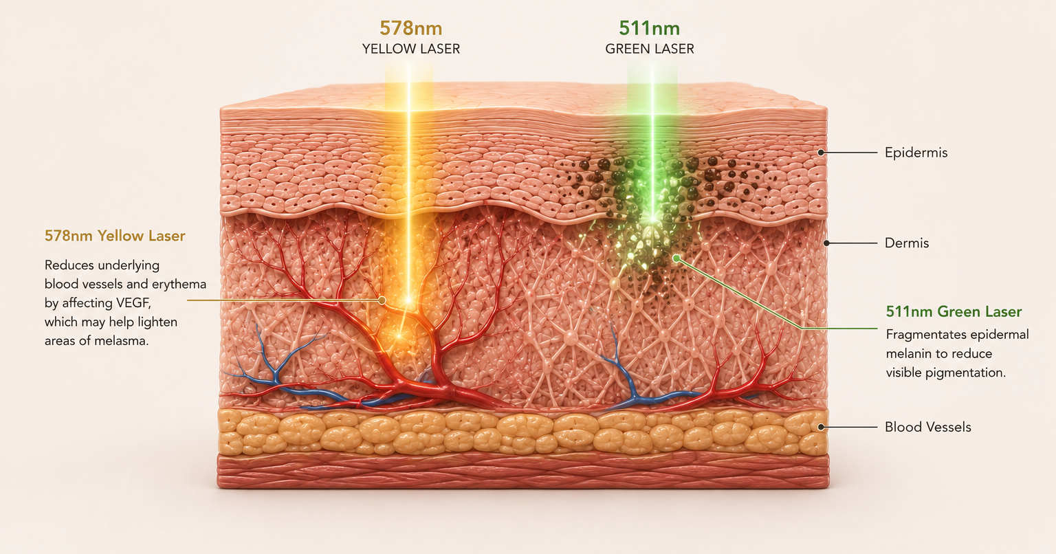 Diagram of skin layers showing the effects of 578nm yellow laser and 511nm green laser. The yellow laser reduces blood vessels and erythema, helping to lighten melasma, while the green laser fragments melanin to reduce pigmentation. Labels include epidermis, dermis, blood vessels, and laser types.