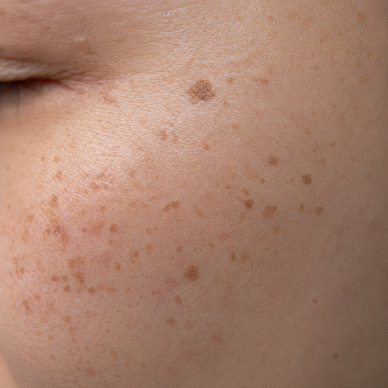 Close-up of a person's facial skin showing freckles and moles near the eye.