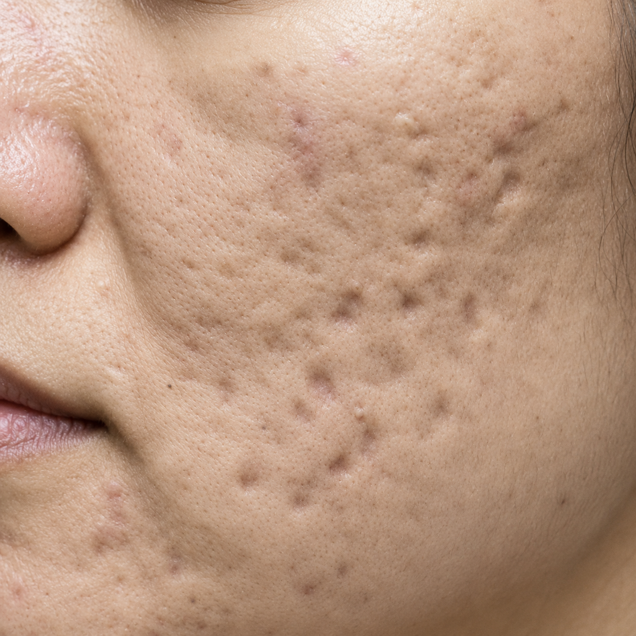 Close-up of a person's face showing acne scars and uneven skin texture.