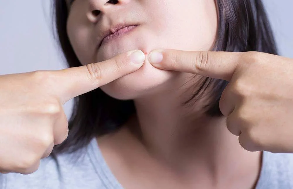 Why Your Acne Keeps Coming Back Even After Your Breakouts Improve