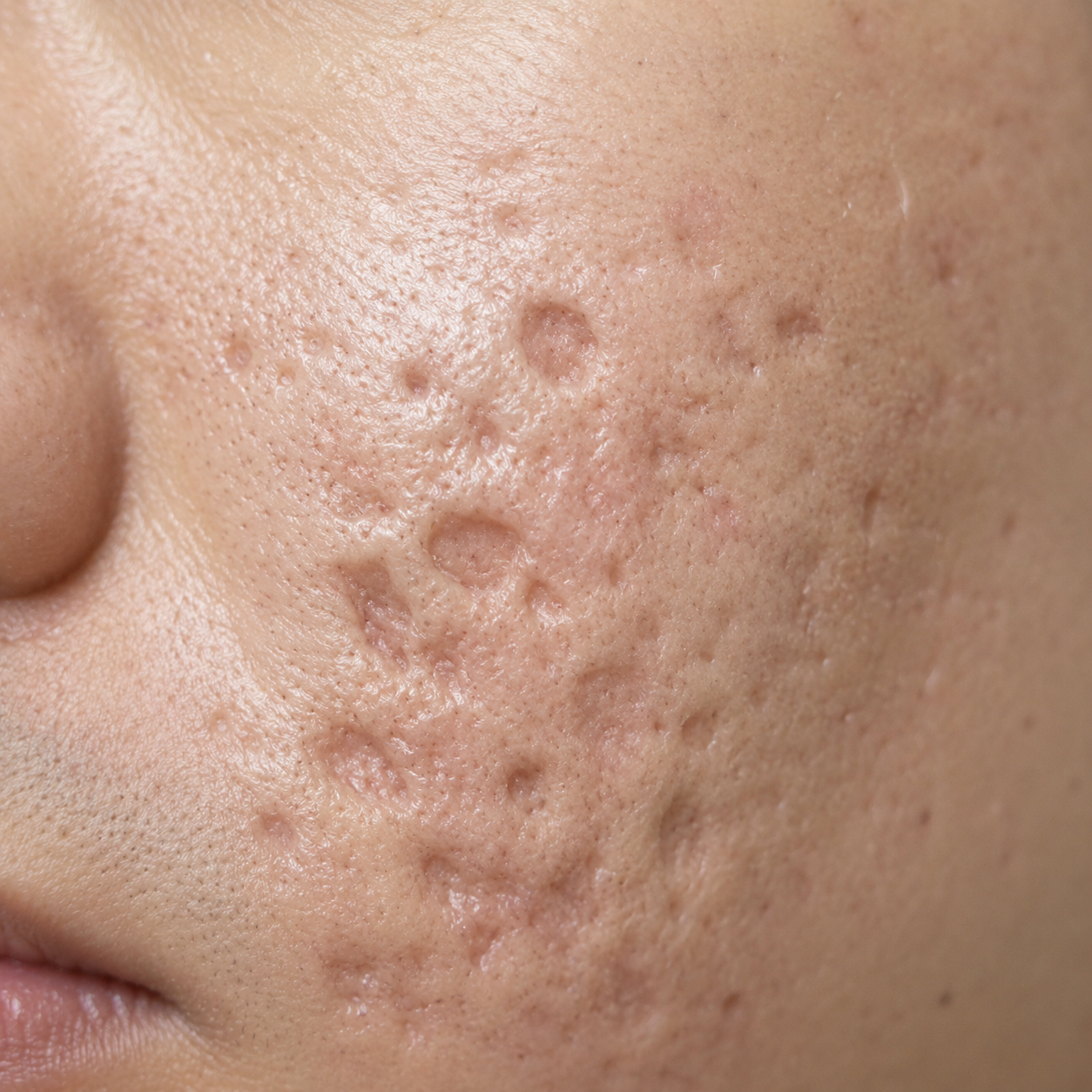 Close-up of a person's face showing acne scars, enlarged pores, and uneven skin texture.