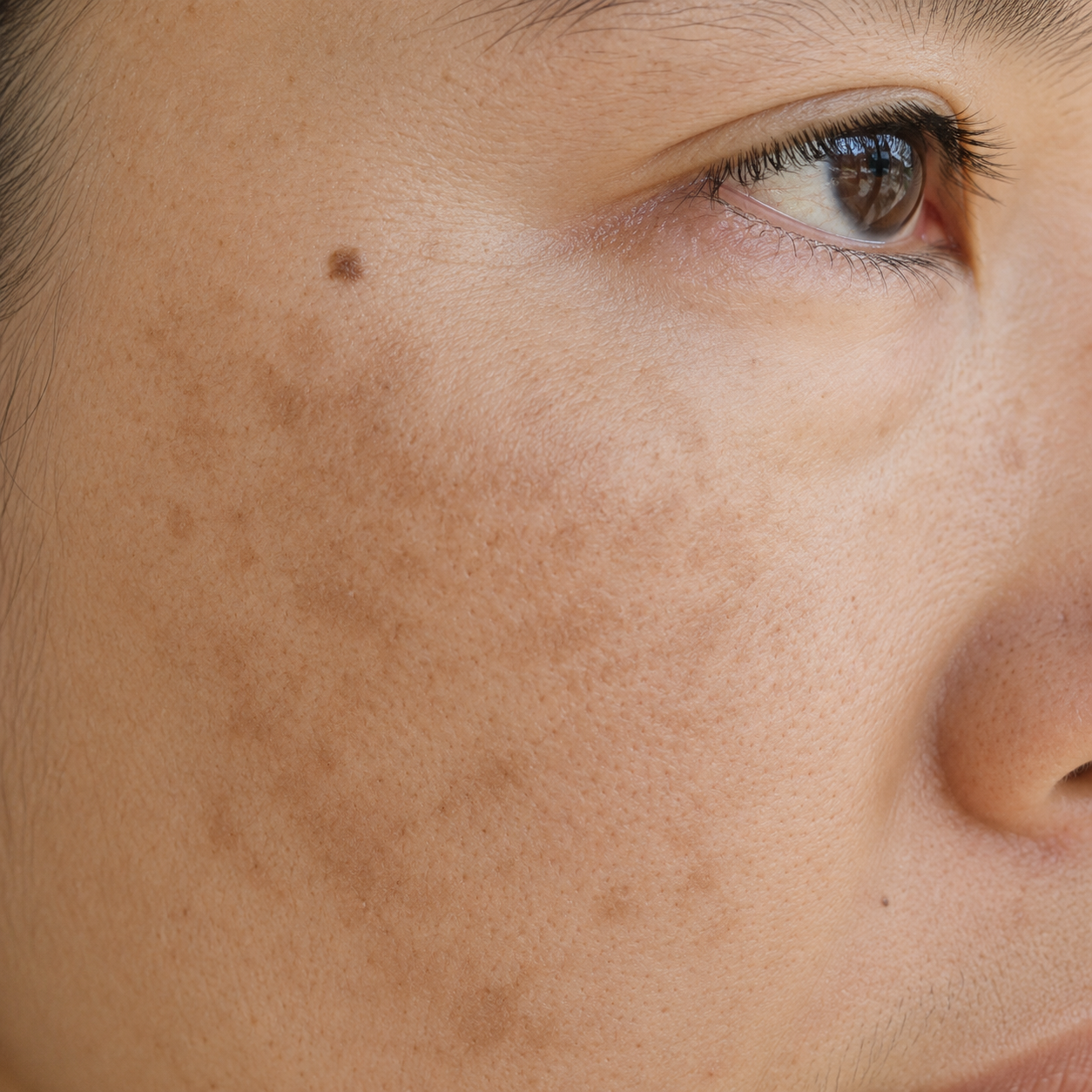 Melasma, Sunspots Or Deep Pigmentation: Why Correct Diagnosis Matters