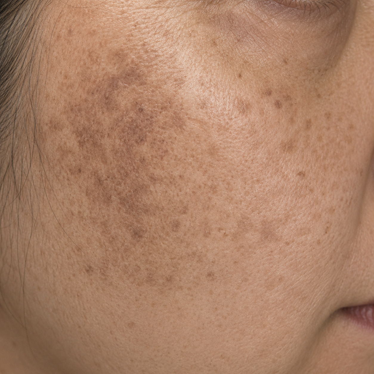Close-up of a person's cheek with hyperpigmentation, dark spots, and uneven skin tone.