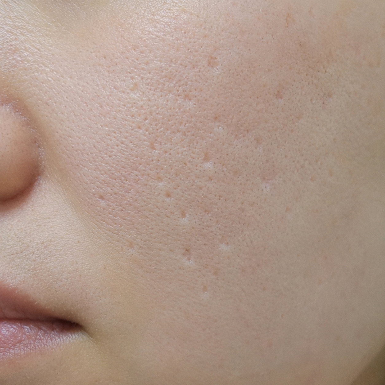Close-up of a person's cheek showing skin with visible pores, small white bumps, and smooth skin texture.