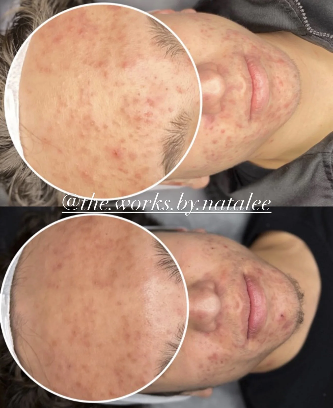 Professional acne treatment results showing smoother skin texture and reduced acne redness