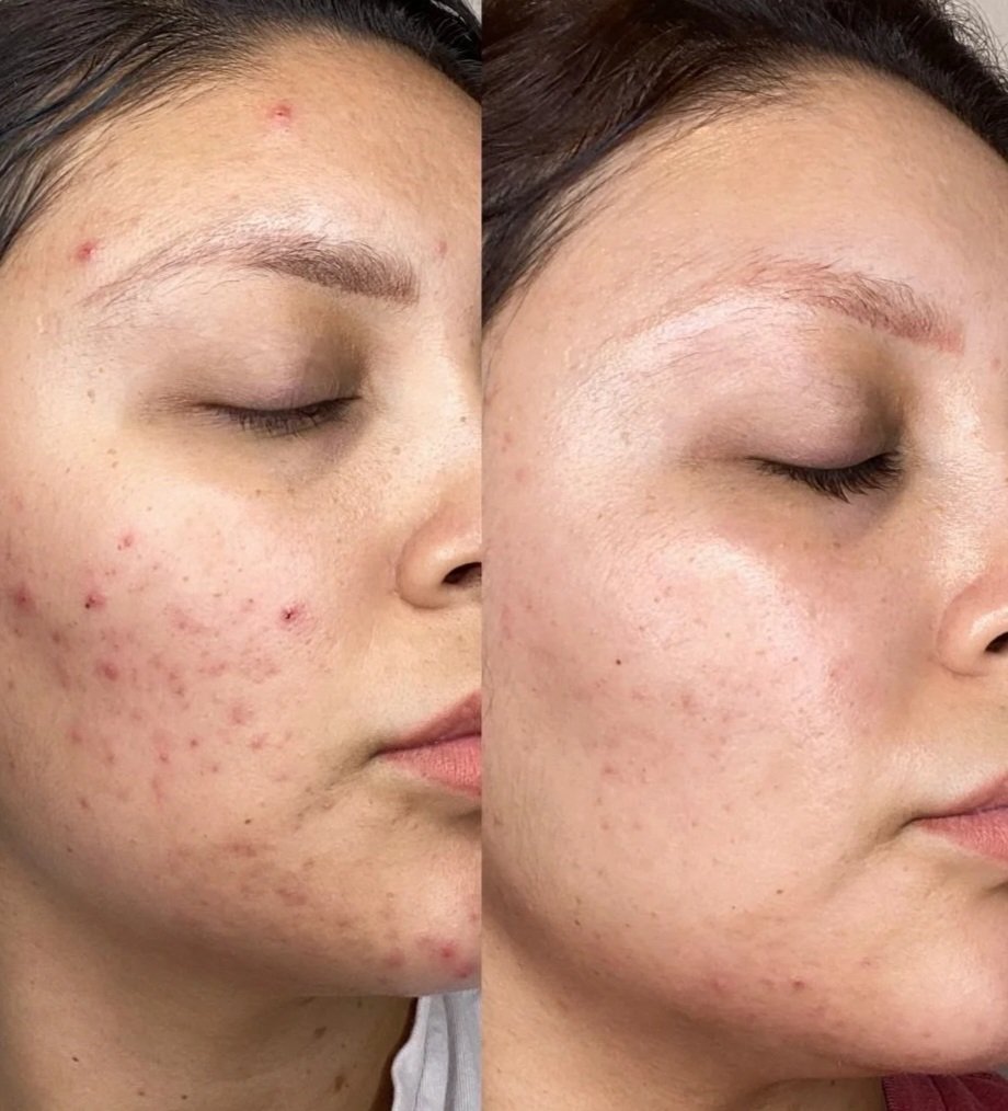 Acne treatment progression showing clearer skin and reduced blemishes after professional skincare sessions
