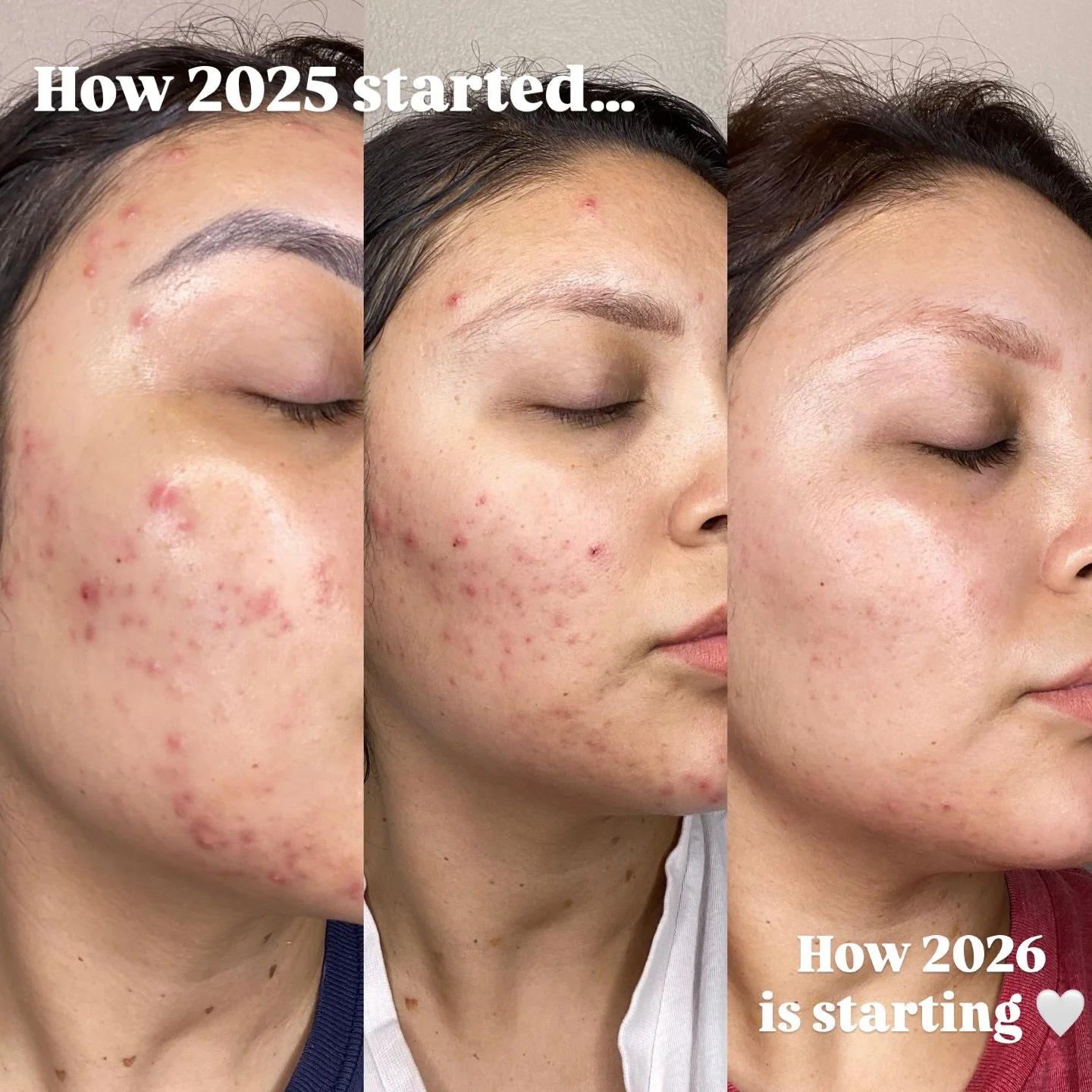 Acne treatment progression showing clearer skin and reduced blemishes after professional skincare sessions