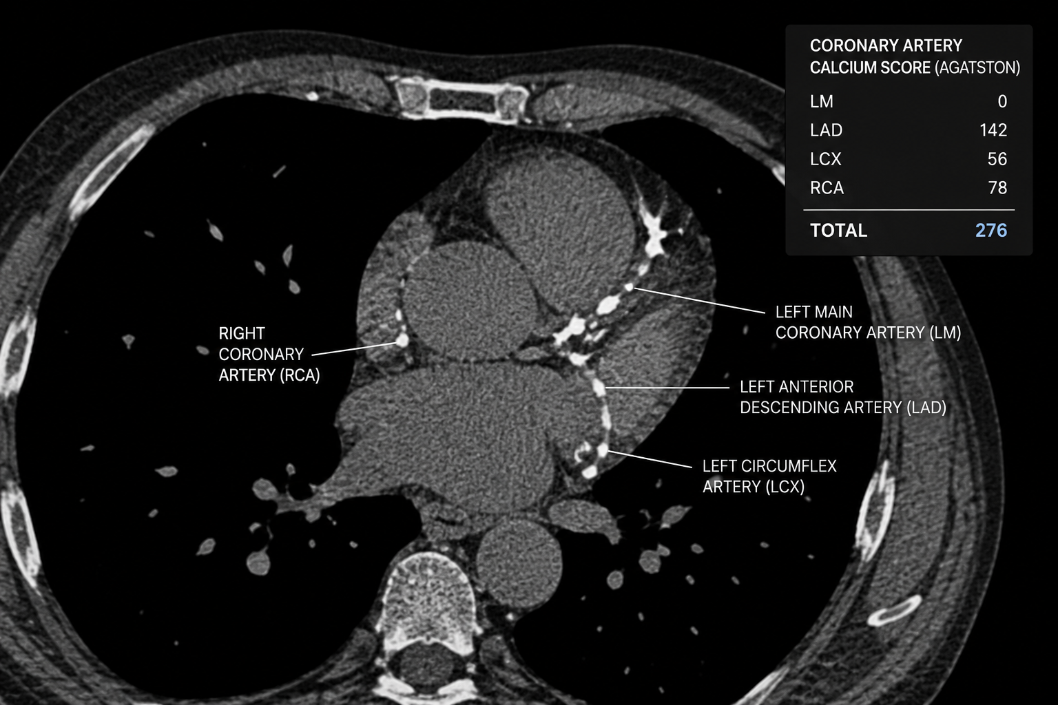 CT scan of the chest showing coronary arteries, with labels for right coronary artery, left main coronary artery, left anterior descending artery, and left circumflex artery, along with a table displaying calcium scores for each artery and the total score.