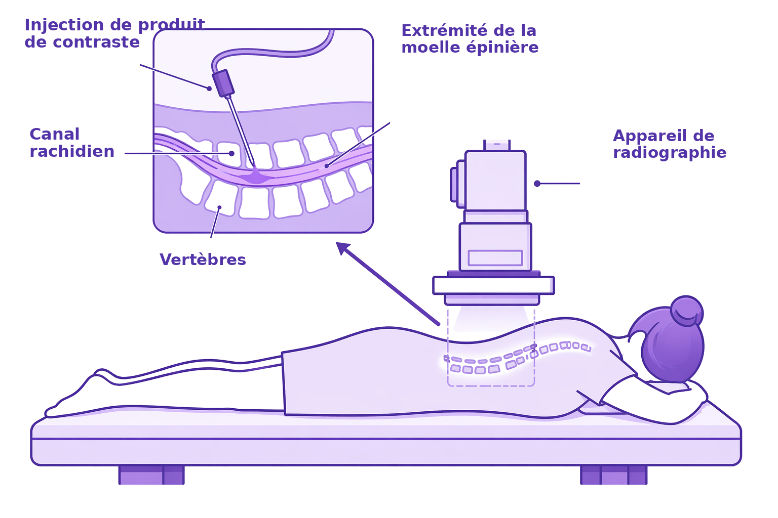 Myeloscanner_hypotension_intracranienne