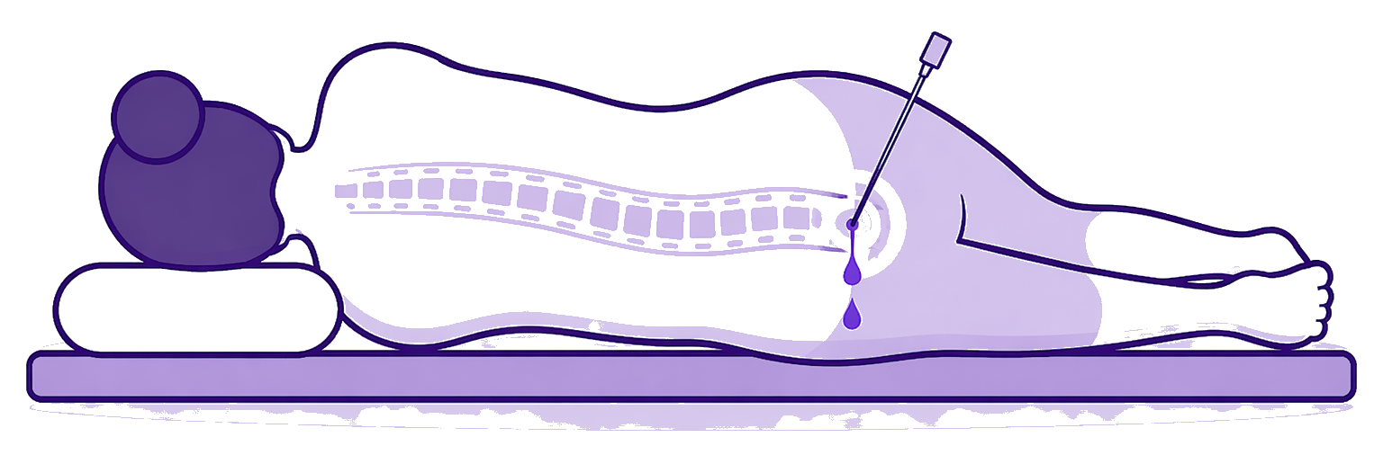 Position patient pour recevoir un blood patch