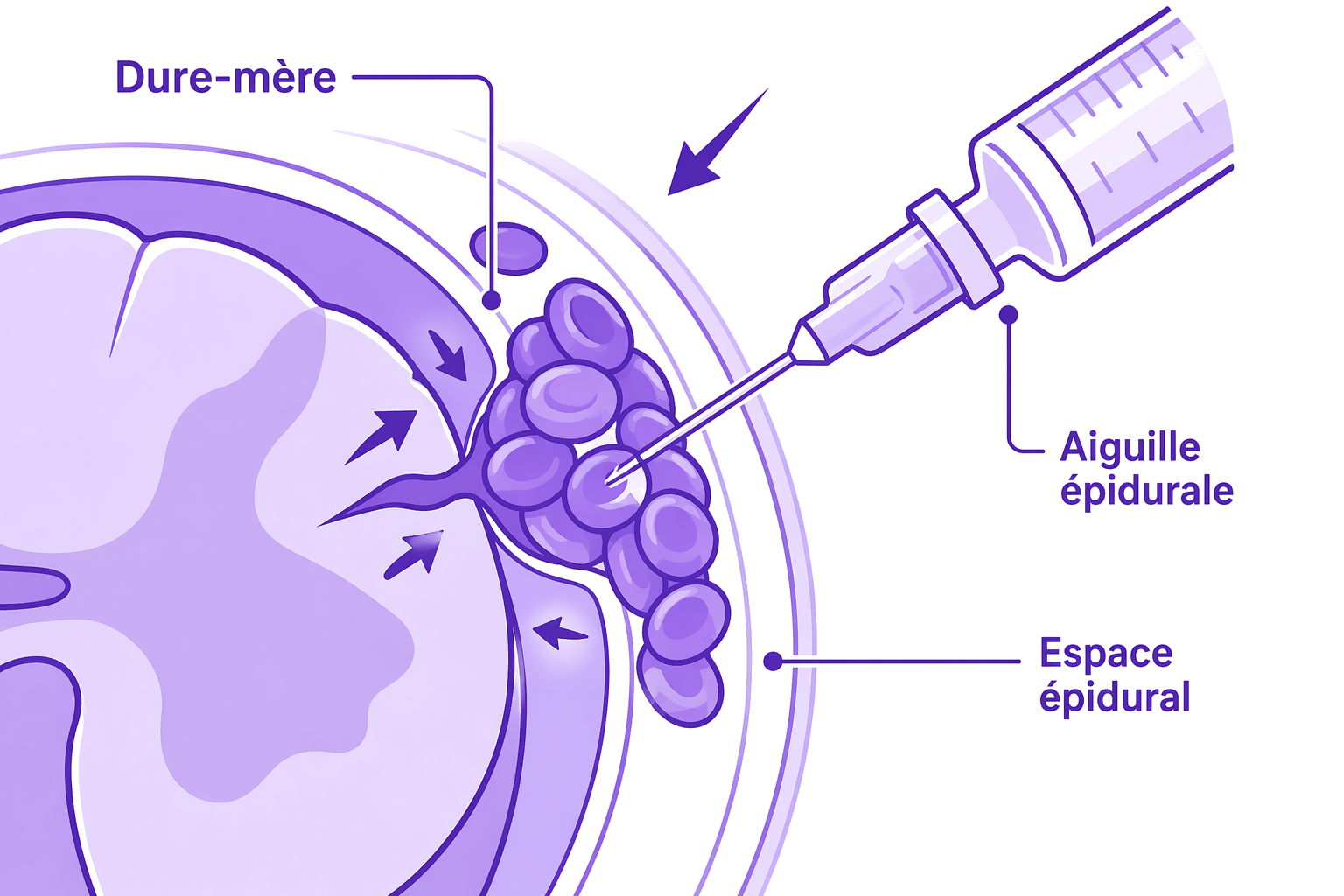 Illustration médicale montrant une procédure de blood patch avec une injection de sang dans l'espace épidural.