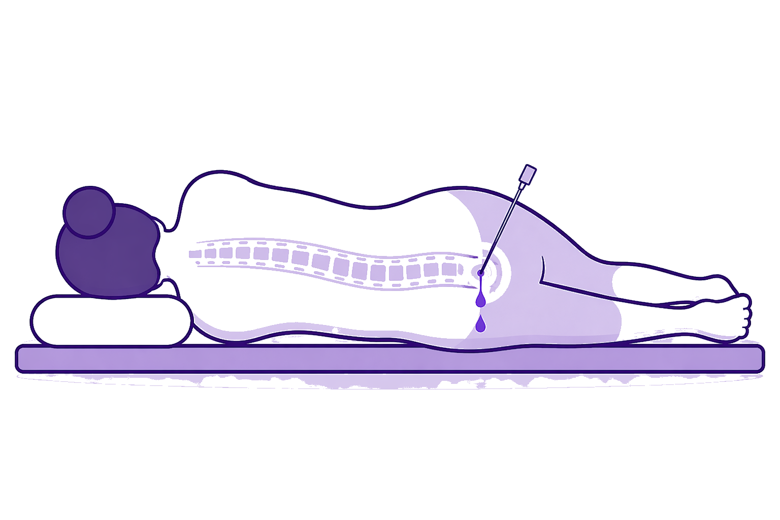 Position patient pour recevoir un blood patch.png
