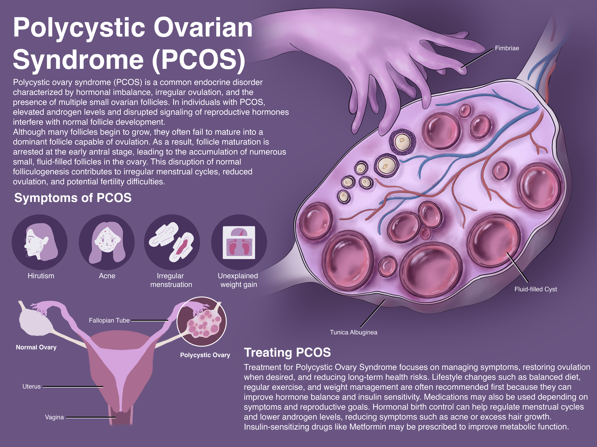 Polycystic Ovarian Syndrome_thai.png