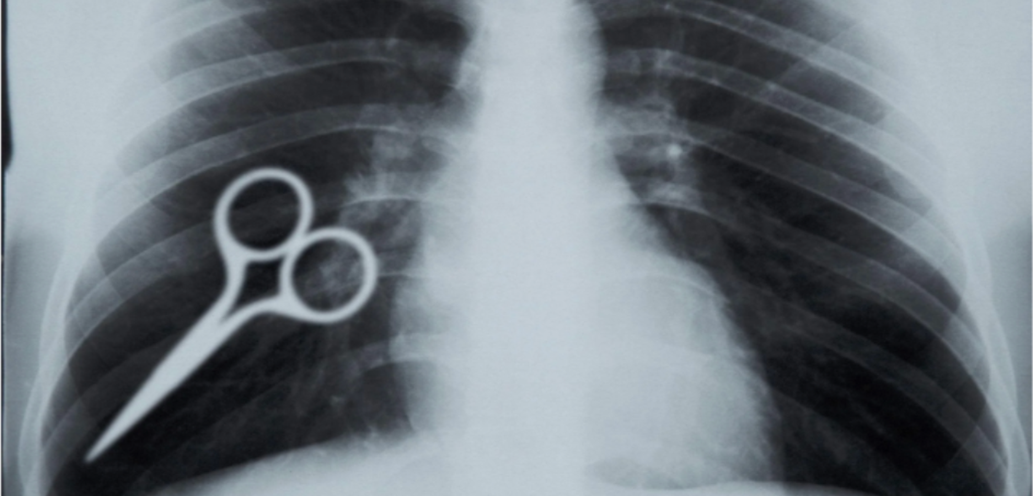 Chest x-ray showing a medical device in the left lung