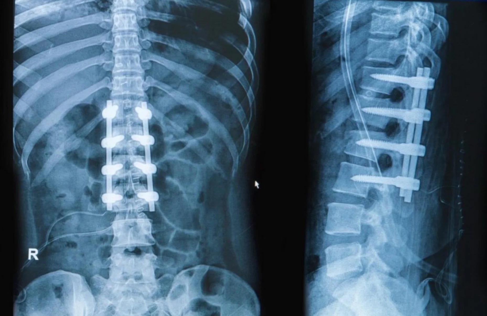 Back Surgery Outcomes May Include FBSS