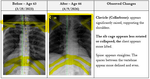 Comparison of X-ray images of a person's upper spine and shoulders taken before age 63 and after age 66. The images show changes in the clavicle, rib cage, and spine, with the clavicle appearing more raised, the rib cage less rotated or collapsed, and the spine straighter in the recent image.