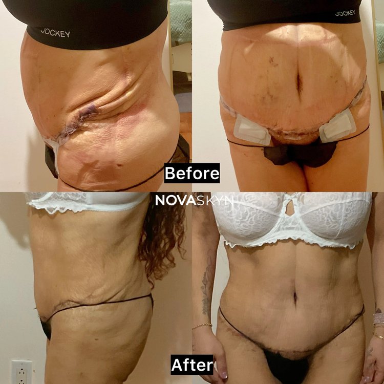 Before and after: Tummy Tuck 360, 4 weeks of Advanced Recovery
