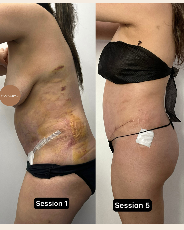 Session 1 and session 5: Tummy Tuck 360, 10 weeks of Advanced Recovery