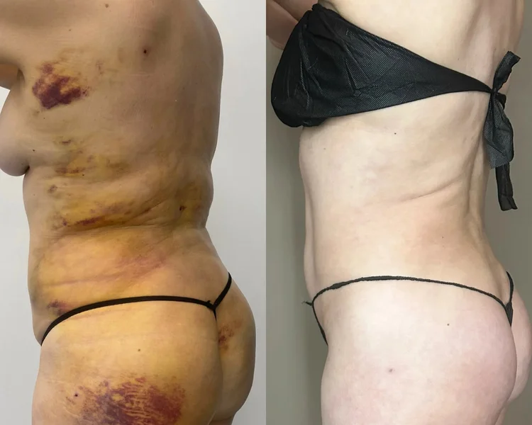 Before and after: Lipo 360 + BBL, 8 weeks of Advanced Recovery