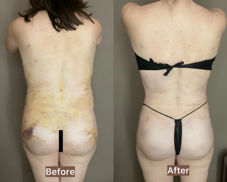 Before and after: Lipo Back + BBL, 5 weeks of Essential Recovery