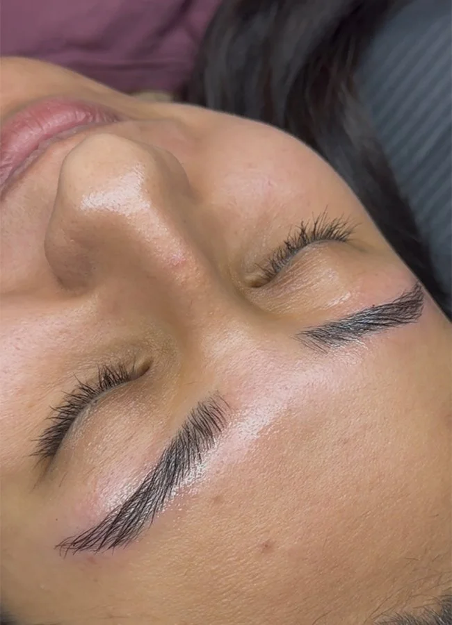 Microneedling in Green Valley, AZ
