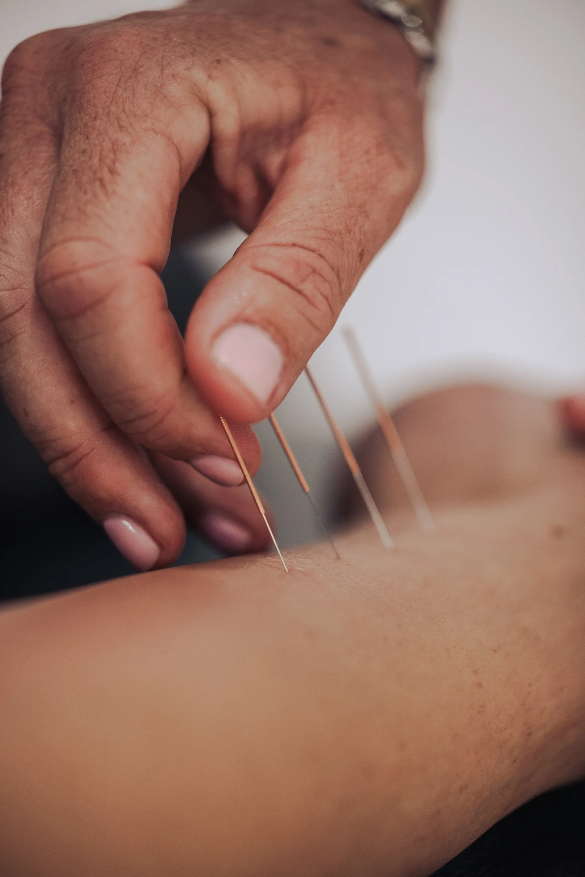 Close-up of acupuncture needles inserted into a person's skin during an acupuncture treatment.