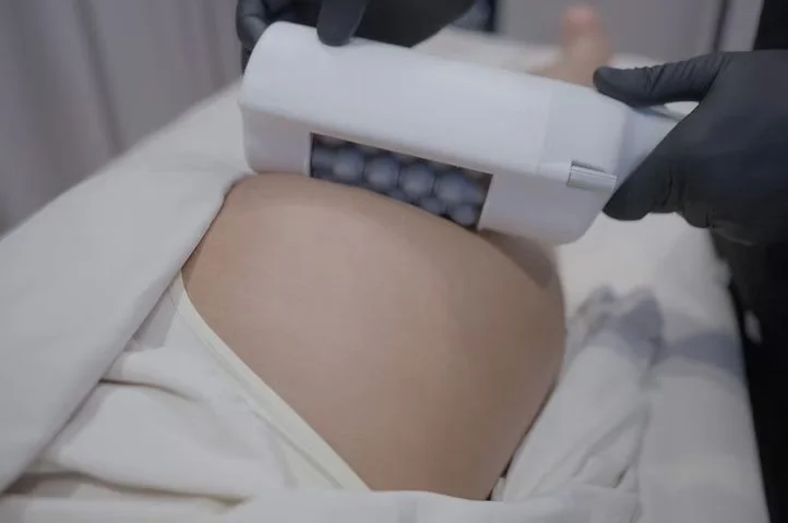 A person lying on a medical bed receiving an cryotherapy treatment on their abdominal area, with a healthcare professional holding a cold spray device.